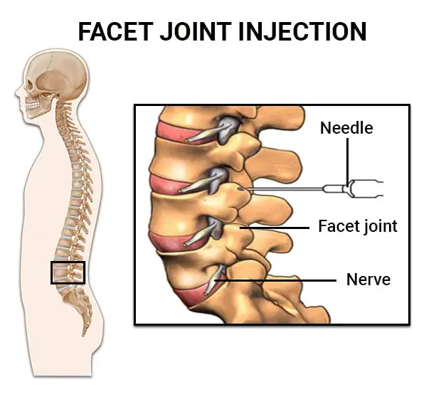 facet injection procedure