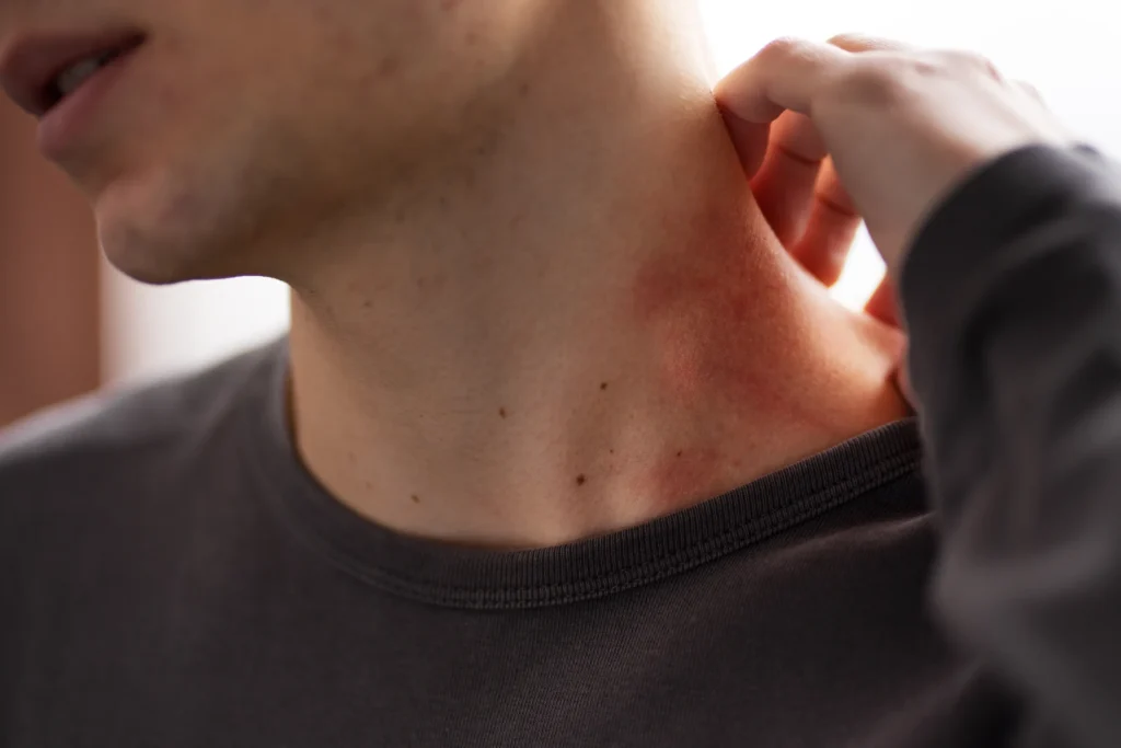 shingles doctor near me