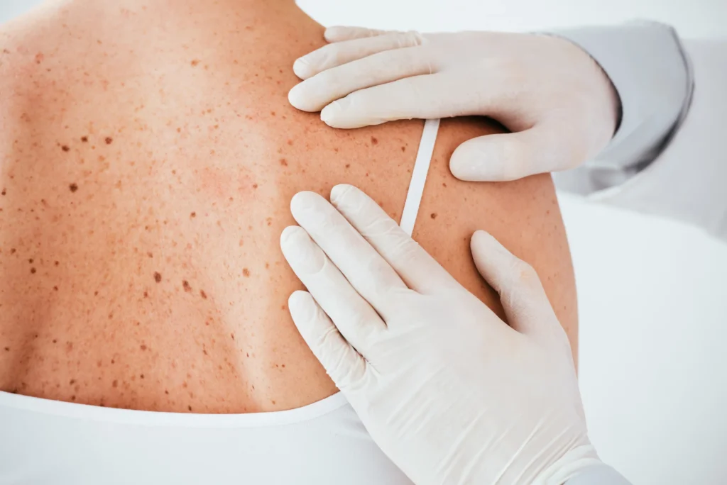 shingles specialist near me